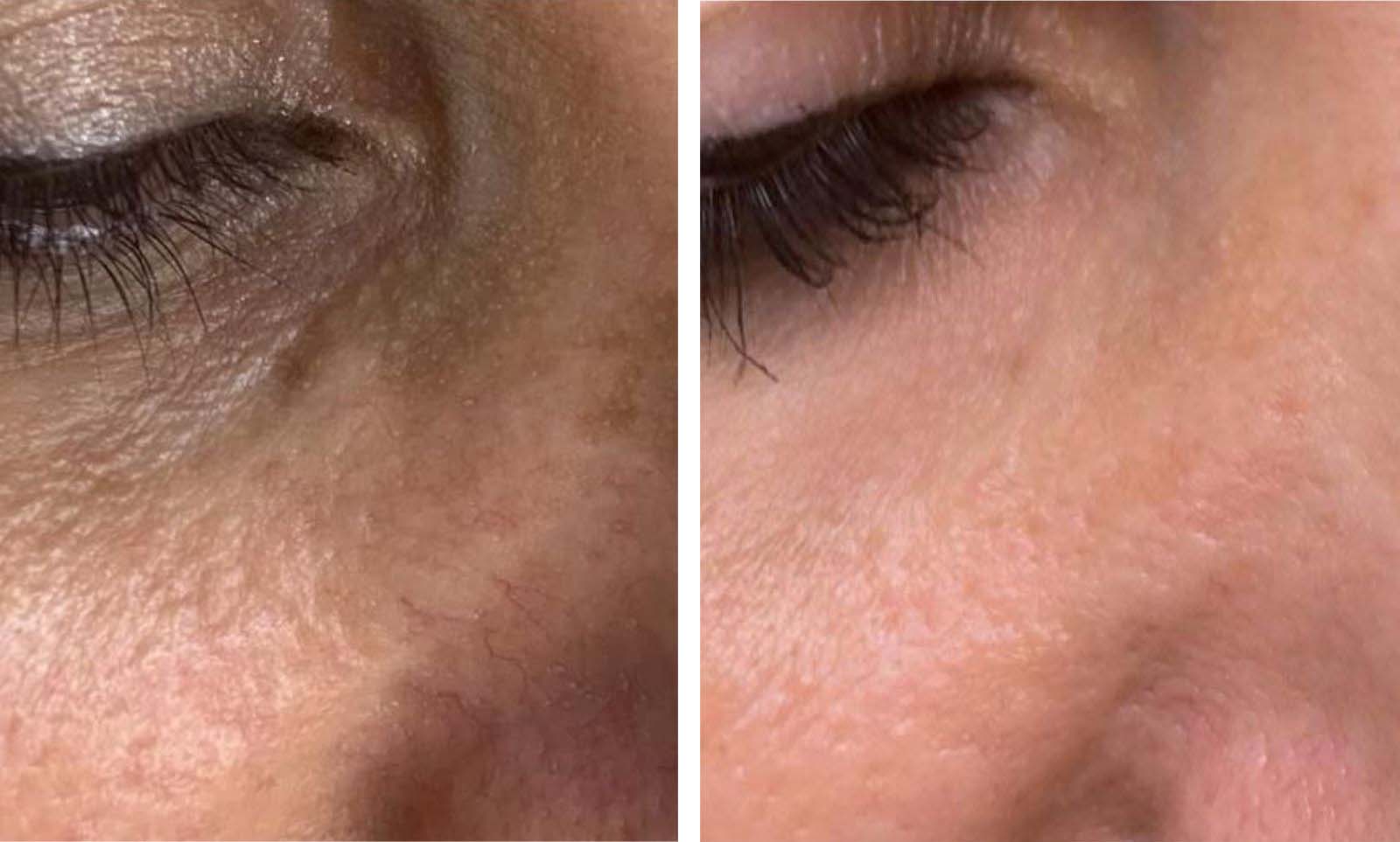 clearlight-ipl-review2